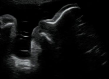 34 weeks 2D ultrasound picture of baby's profile.