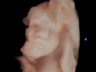 3D Ultrasound Picture in Virtual HD of Baby's Face.