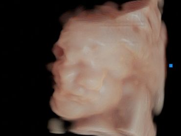 3D Ultrasound Picture in Virtual HD of Baby'sface,