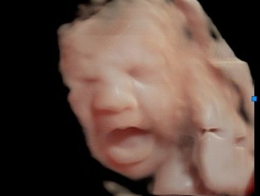 3D Ultrasound Picture in Virtual HD of Baby yawning.