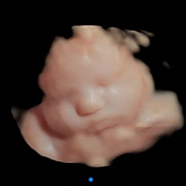 3rd trimester 3D ultrasound face picture in virtual HD