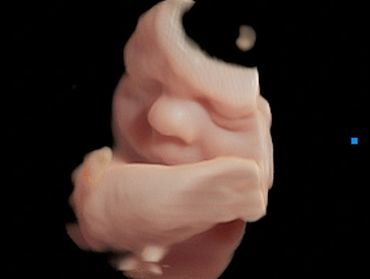 3D Baby Ultrasound Picture of side of baby's face