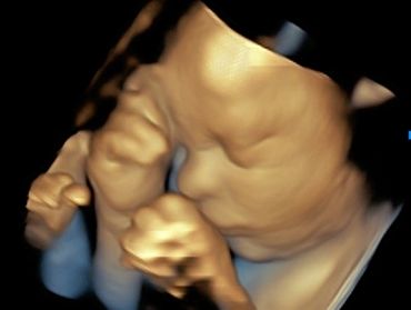 3D Baby Ultrasound Picture of side of baby's face with arms up