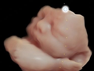 3D Baby Ultrasound Picture of Baby with Arm under chin