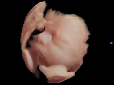 3D Baby Ultrasound Picture of side of baby's face