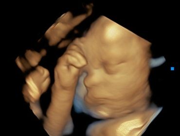 3D Baby Ultrasound Picture of Baby with Arm over face