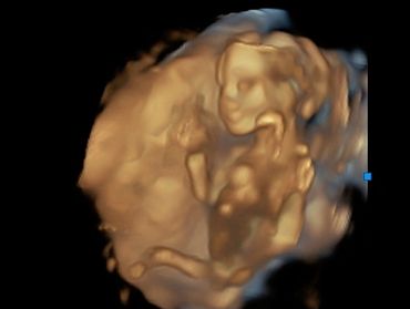 3D ultrasound baby picture full body