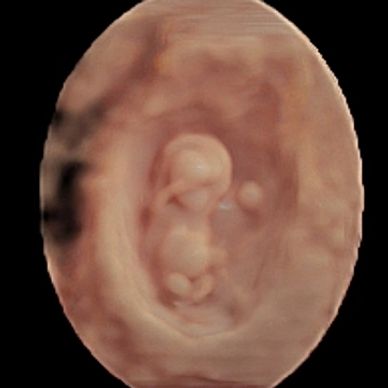 3D ultrasound picture of 12 week baby with yolk sack