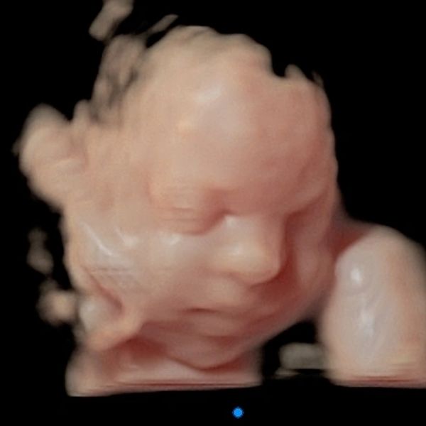 Baby 3D Ultrasound Picture baby face
