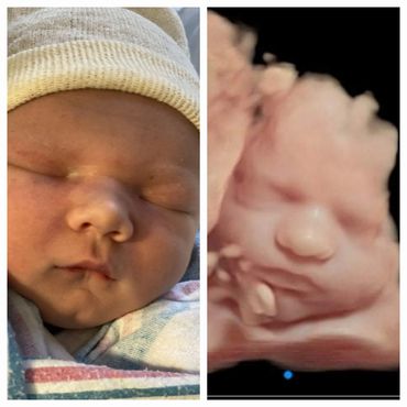 Before and After Baby 3D Ultrasound Picture puckered lips
