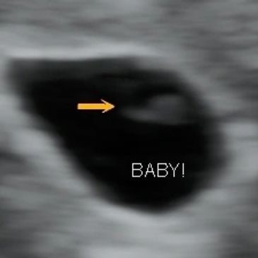 2D ultrasound picture of baby at 5 weeks 6 days.