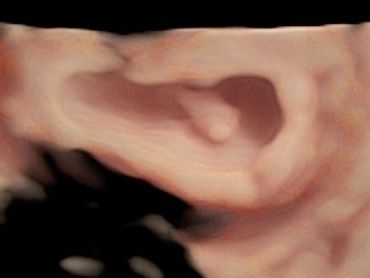 7 Weeks 2 Days 3D Ultrasound Picture of Baby in the Uterus.