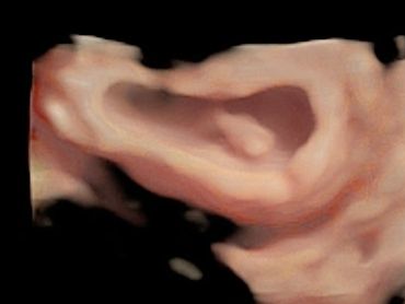 7 Weeks 2 Days 3D Ultrasound Picture of Baby in the Uterus.