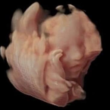 Baby 3D Ultrasound Picture  fingers near face