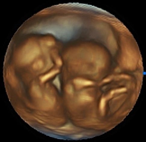 The Moment That Changed Everything: Discovering Twins