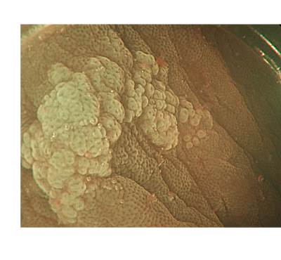Sessile serrated lesion clearly delineated after the use of acetic acid