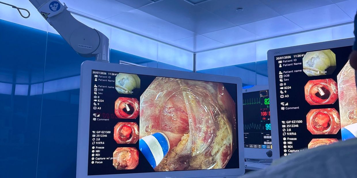 Medical endoscopy displayed on monitors in a sterile room.