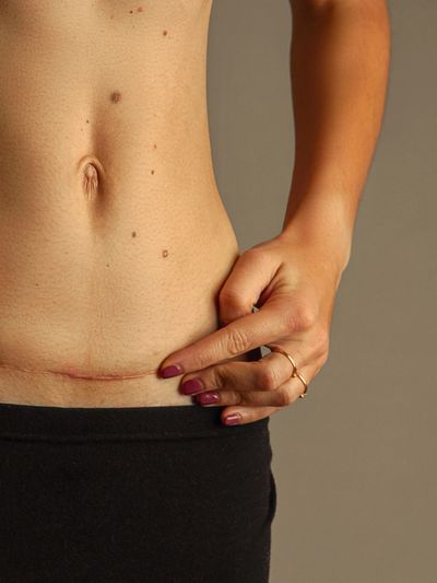 Close-up of a woman's lower abdomen showing a cesarean section scar.