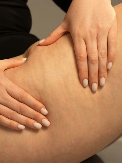 Hands gently pressing on a thigh with visible cellulite.