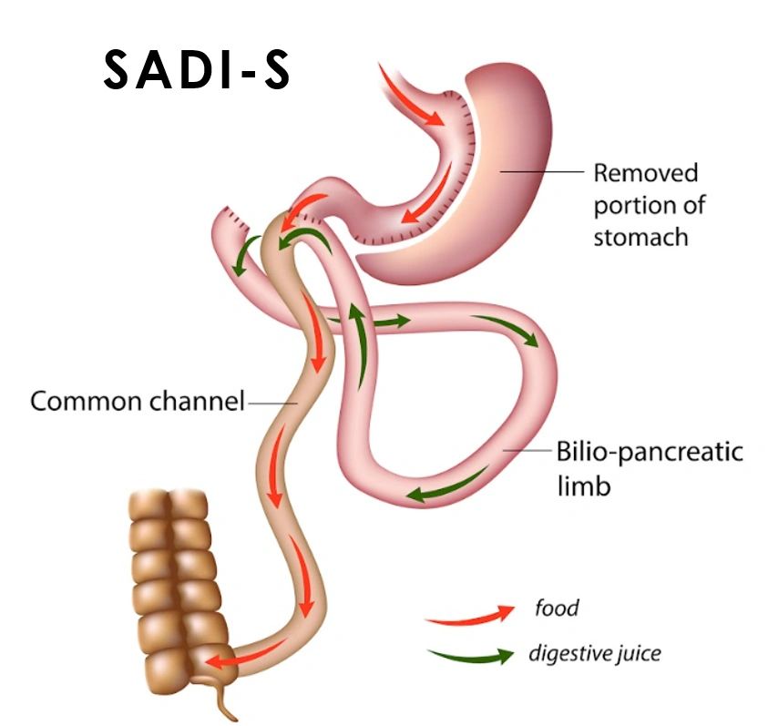 single anastomosis duodenal switch illustration