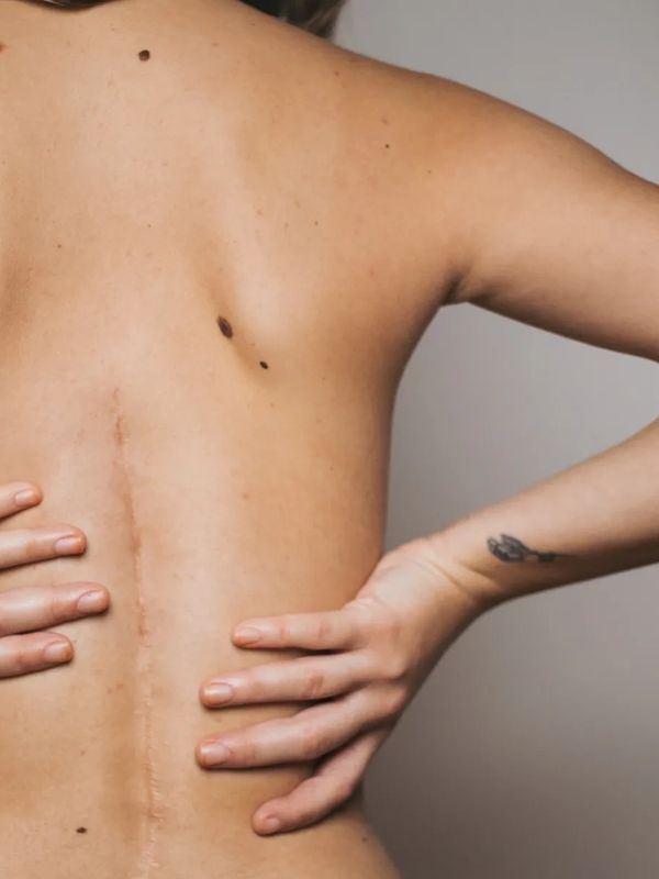 Close-up of a person's back showing a surgical scar and tattooed wrist.