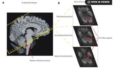 Brain MRI slices showing functional and anatomical views with CSF inflow signals.