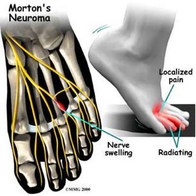 Plantar Fasciitis, Neuropathy, Leg Cramps, Hip Pain, Diabetes, Back Pain, Arthritis, Mortons Neuroma