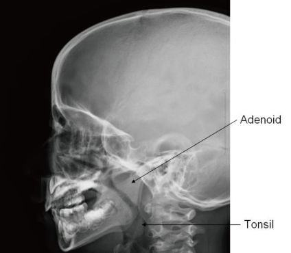 X-Rays - Cephalometric X-ray