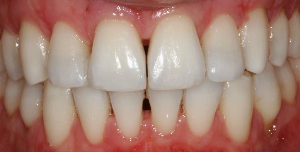 Interproximal Reduction (IPR), aka Polishing or Shaving Teeth Pt1