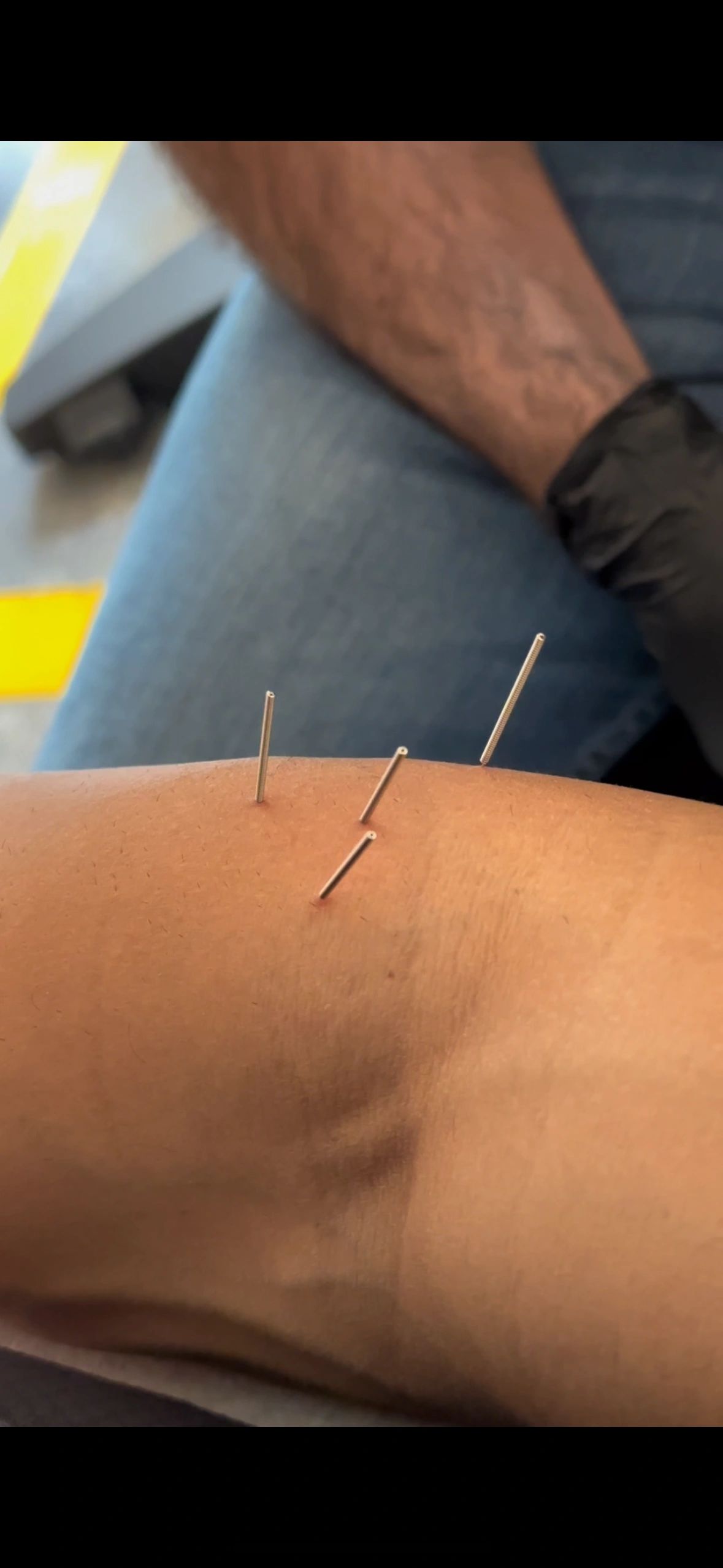 Dry needling at PT Boutique