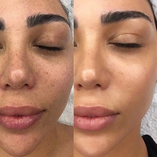 microneedling with glutathione benefits The of celimax glutathione cream Scent:Fresh Citrus Scented Clinical Glutathione™ - EuroMedica