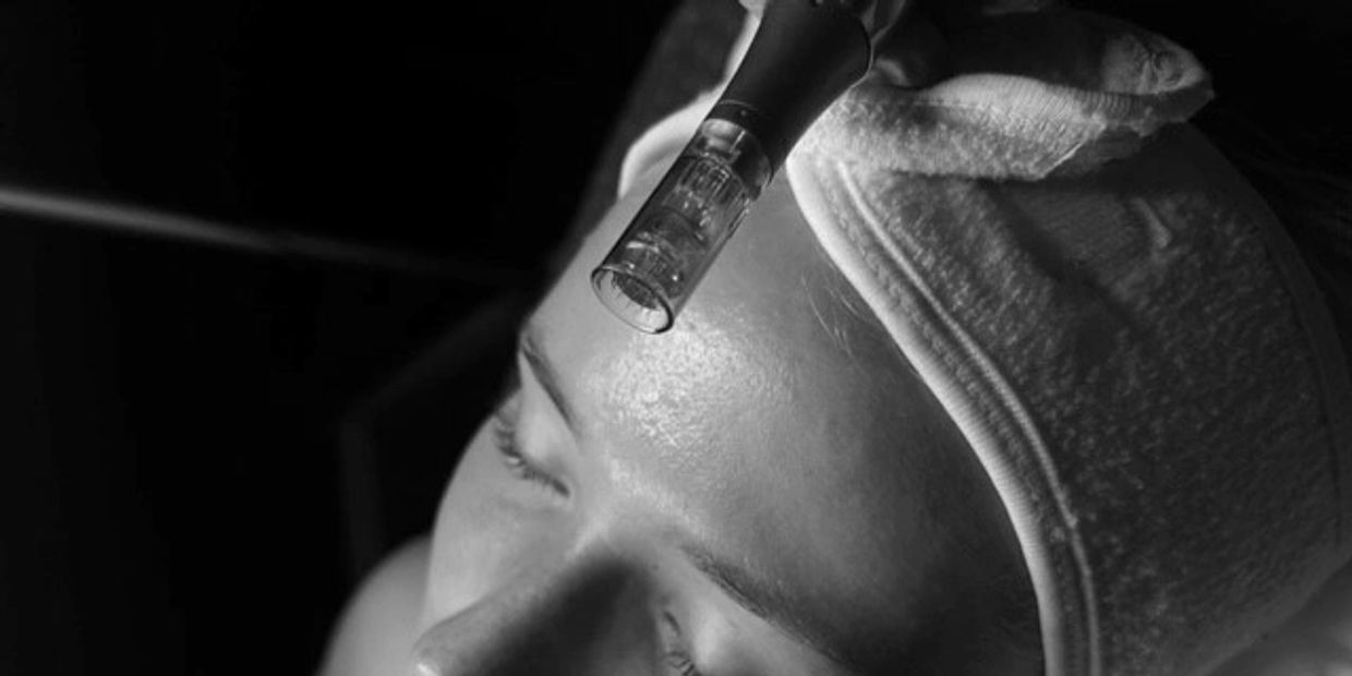 Woman receiving a microneedling facial treatment with eyes closed.