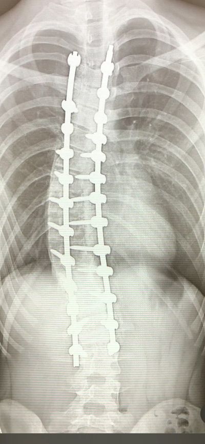 Scoliosis