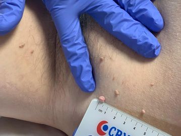 Cryrotherapy image