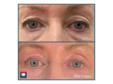 skin tightening