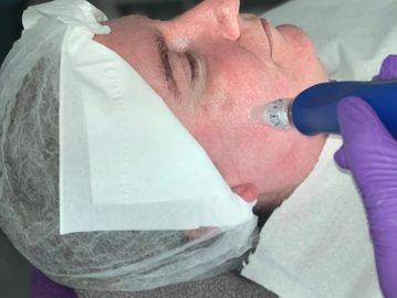 LEVEL 4 SKIN NEEDLING