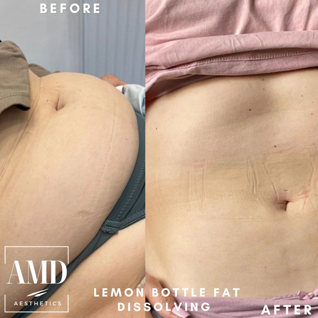 how to store lemon bottle fat dissolving Anti Wrinkle Injections