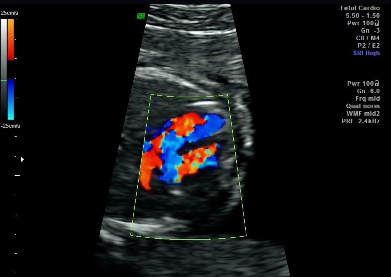 Acnormal Usg Week 19-24 week Diagnostic Anomaly Scan