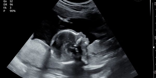 Fetal Profile Ultrasound