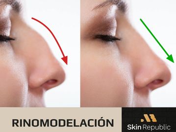 Rinomodelacion, Rhinoplasty, Nose modelling, acido hialuronico