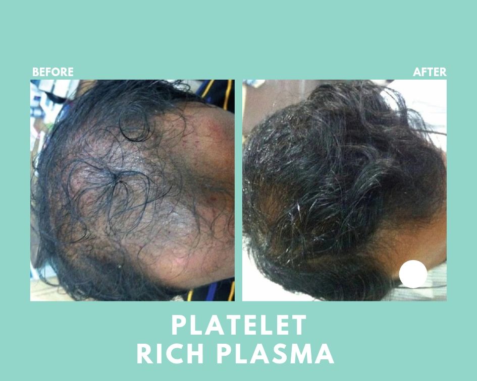 Platelet-Rich Plasma (PRP)- for hair loss Platelet-Rich Plasma (PRP)- for hair loss