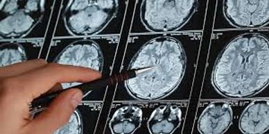 lifestyle and dementia Alzheimer's preventable brain scan CBS News video