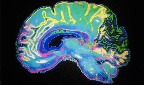 difference between dementia and Alzheimer's video brain activity what happens