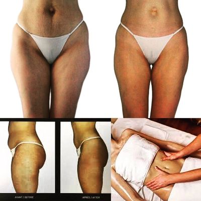 Essential Health & Healing Hands - Effective Cellulite Treatment