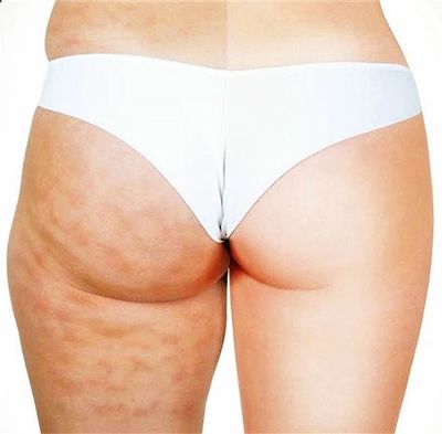 How Anti-Cellulite Massage Helps To Reduce Weight