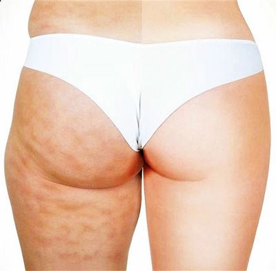 Essential Health & Healing Hands - Effective Cellulite Treatment