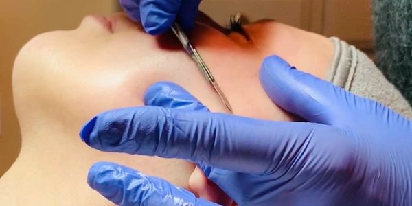 Micro-needling facial