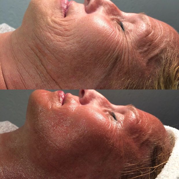 Cryofacial - Facial with Cryoskin