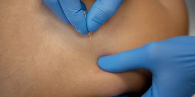 A needle in being inserted into a shoulder muscle at a dry needling appointment