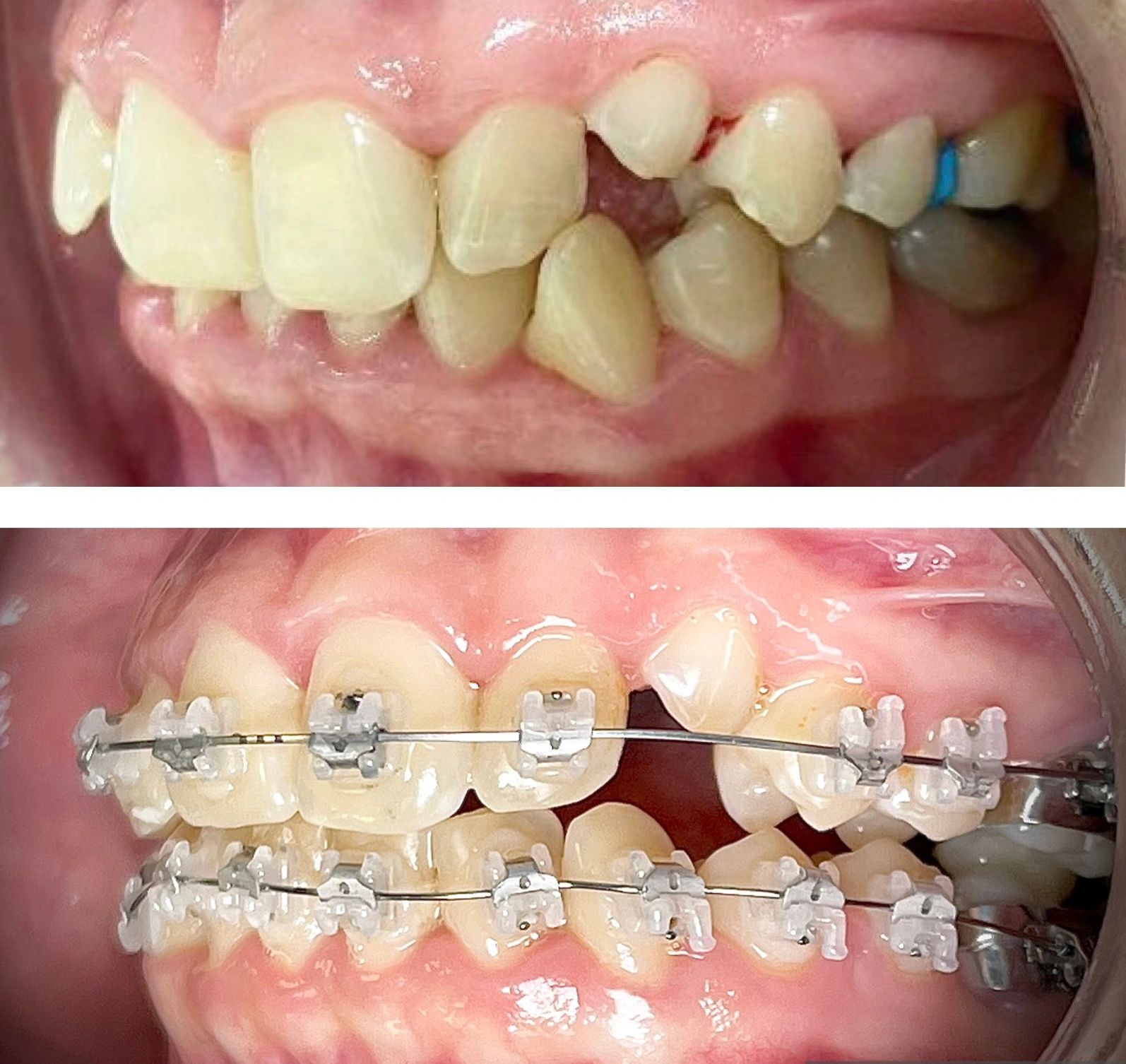 SelfLigating ceramic Brackets in a case of upper impacted canine